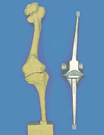 Стандартный протез коленного сустава и трехмерная модель