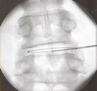 Контроль рентгеновским аппаратом при проведении ВЭТ